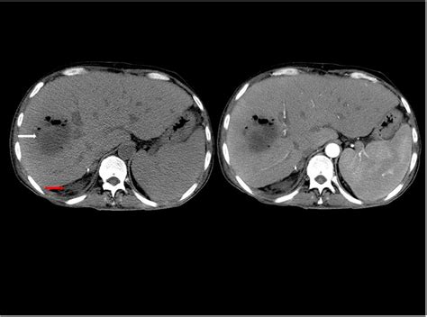 Complications Of Liver Biopsy Intechopen