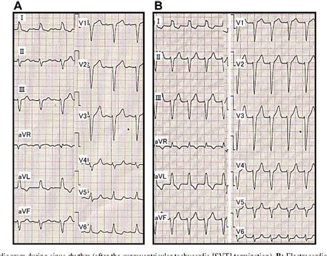 Figure 1 From A Case Of Typical And Atypical Atrioventricular Nodal Reentrant Tachycardia With A