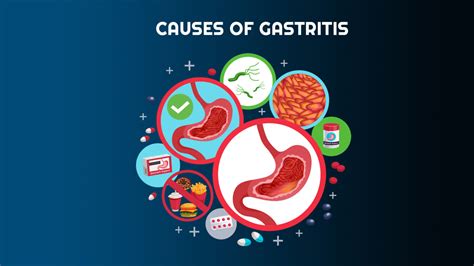 Gastritis Types