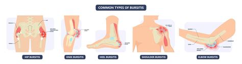 Bursitis Symptoms Progressive Sports Medicine Leichhardt