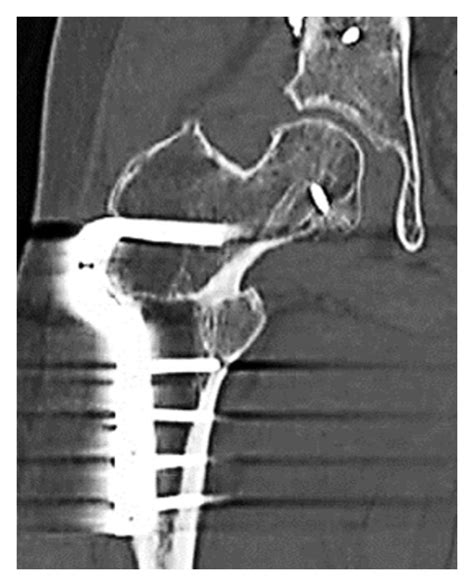 Case A Anteroposterior X Ray Image Of The Right Hip After A Pauwel