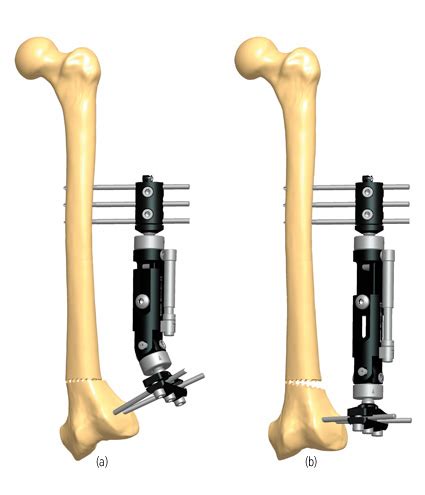 A For Correction Of Deformity Orthofix