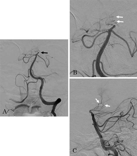 Dsa Findings Are Shown A Left Vertebral Artery Angiogram Revealed