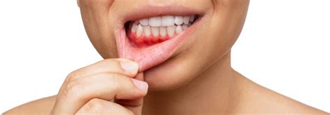 Can Gum Disease Be Reversed