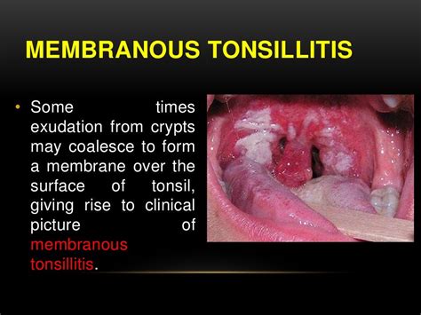 Tonsillitis