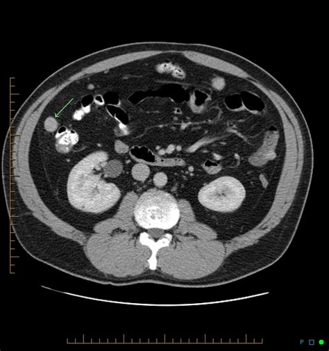 Splenosis Image