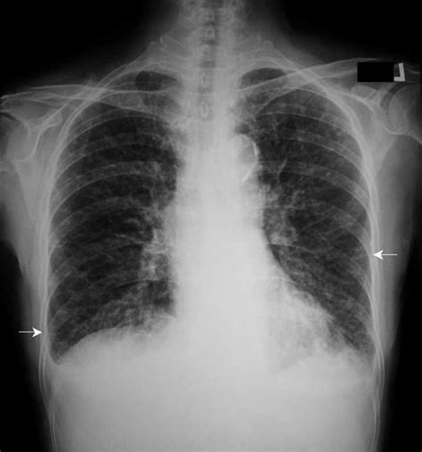 Diffuse Interstitial Lung Disease Pictures