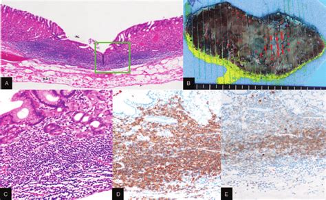 Histopathological Examination Of Resected Specimen A Low Power View