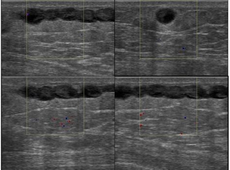 Figure 1 From Sono Mammographic Findings Of Mondor`s Disease Of The Breast Semantic Scholar