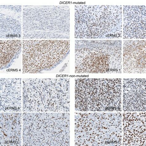 Prame And Ezh Staining In Embryonal Rhabdomyosarcoma Erms For Each