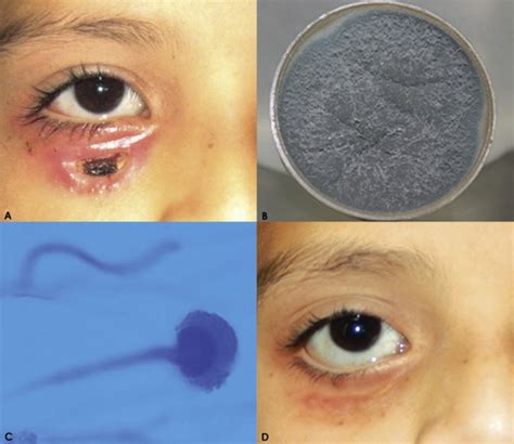 Eyelid Fungal Infections Are Rare And Often Associated With Predisposing Factors We Present