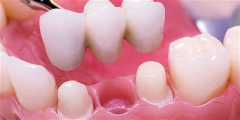 Crowns and Bridges in Karachi - Low Cost Affordable & Effective