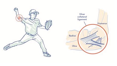 Tommy John Surgery Ucl Injury Overview Dr Christopher Ahmad