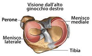 Rottura Del Menisco