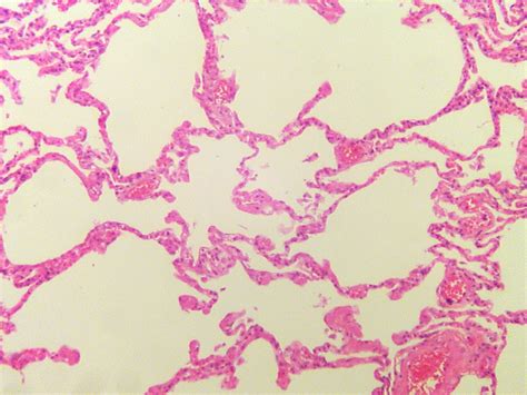 Normal Lung Tissue Vs Cancerous Lung Tissue Cancerwalls