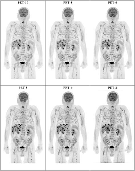 Whole Body Pet Ct Cuts Scan Time In Melanoma Patients