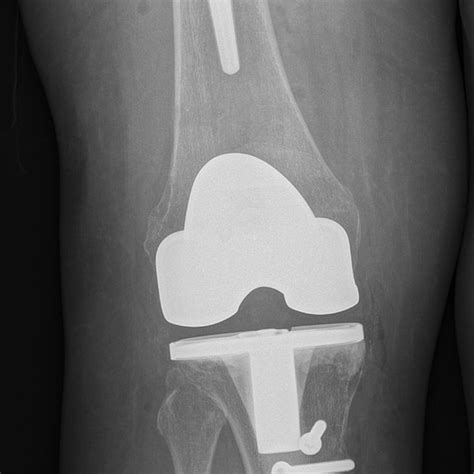 Lateral X Ray Of Tka And Tibial Tuberosity Fixation Tka Total Knee