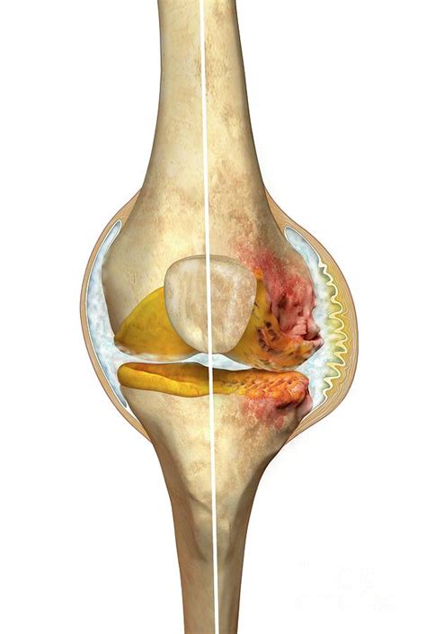 Normal Knee And Knee With Osteoarthritis By Henning Dalhoff Science