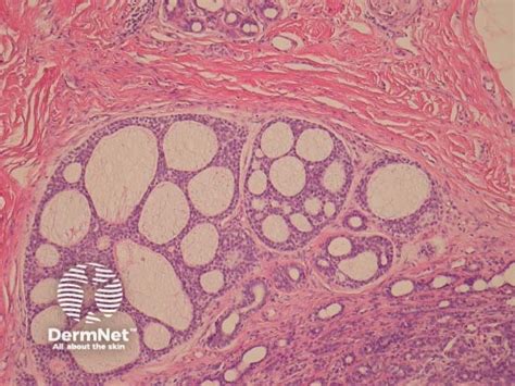 Polymorphous Sweat Gland Carcinoma Pathology