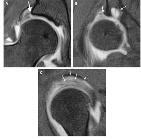 Figure From Imaging Of The Acetabular Labrum Semantic Scholar