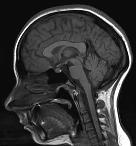 50+ Anatomy Brain Sagittal Mri PNG | diagramisre