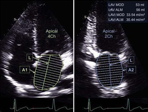 Clinical And Prognostic Implications Of Methods And Partition Values