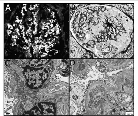 Figure 1 From Bartonella Henselae Endocarditis And Glomerulonephritis