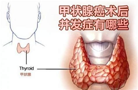 甲状腺癌术后并发症有哪些？ 知乎