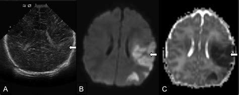 Perinatal Arterial Ischemic Stroke Presentation Risk Factors