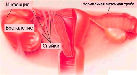 Воспаление придатков у женщин способы лечения причины и меры профилактики