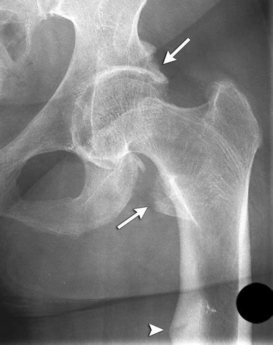 Osteomalacia X Ray