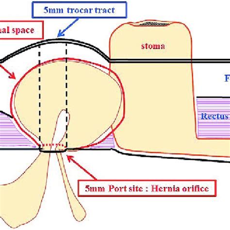 Figure Schematic Illustration Of This Hernia The Hernia Orifice