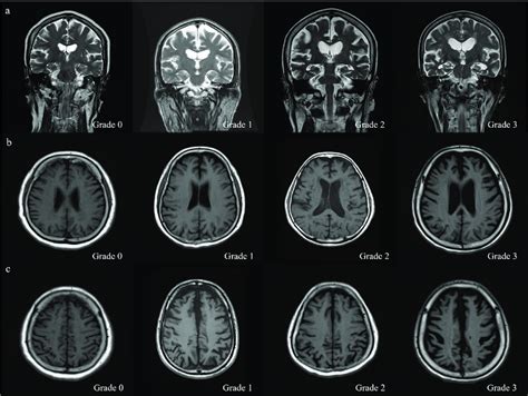 Brain Atrophy In Structural Mri Using Visual Rating Scales A Medial