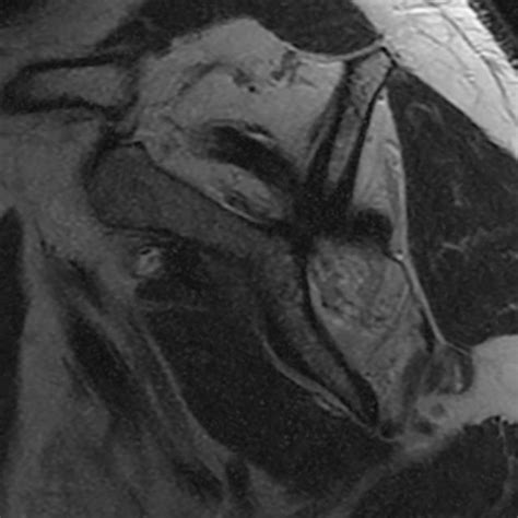 8 Sagittal T1 Weighted Magnetic Resonance Image Demonstrating