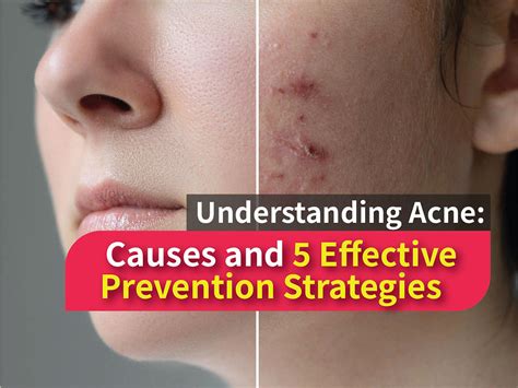 Causes of Acne and 5 Effective Prevention Strategies