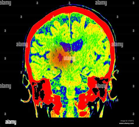 CT Brain Perfusion or CT scan image of the brain axial view showing cerebral blood flow on the ...