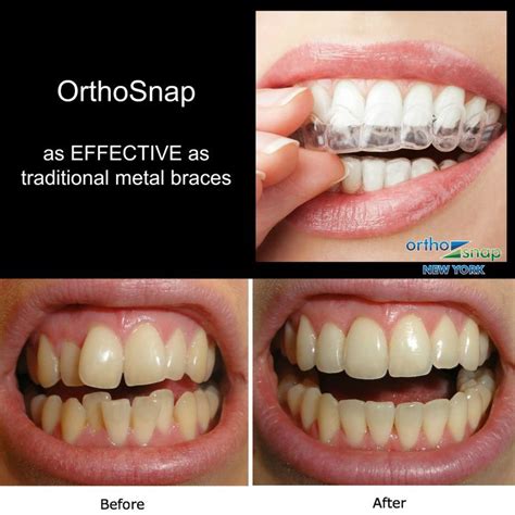 Clear Aligners Orthosnap True And Only Effective Alternative To Traditional Braces