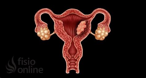 Endometriosis Qu Es Signos Y S Ntomas Tratamiento