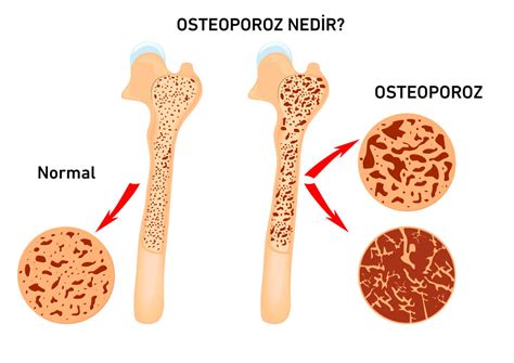 Osteoporoz kemik erimesi nedir Belirtileri ve tedavi yöntemleri