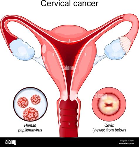 Cervical Cancer Carcinoma Malignant Neoplasm Arising From Cells In