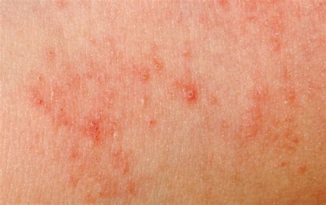 The 10 Most Common Skin Allergies Step To Health