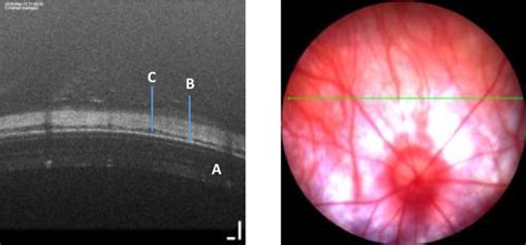 12 Choroidal Thickness Collected By SD OCT In The Rat Using The EDI