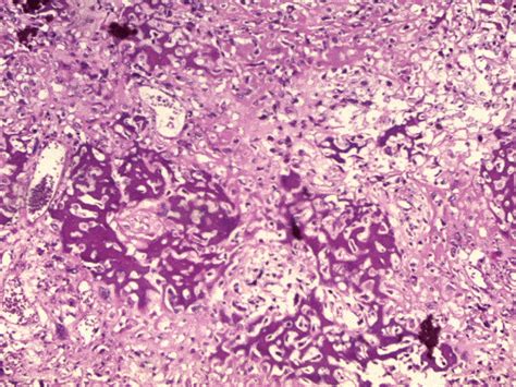 Full Text Neglected Telangiectatic Osteosarcoma Of The Femur