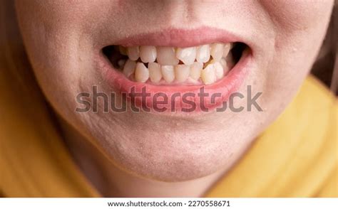 Curved Female Teeth Before Installing Braces Stock Photo