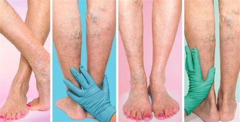 Tips To Prevent Varicose Veins Pain Flowcare