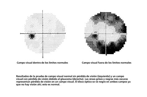 ¿qué Es Una Prueba De Campo Visual Glaucoma Research Foundation