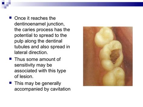 Clinical Features And Histopathology Of Dental Caries PPT