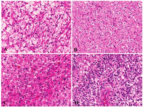 Histological Features Of The Gliomas A Pilocytic Astrocytomas Grade