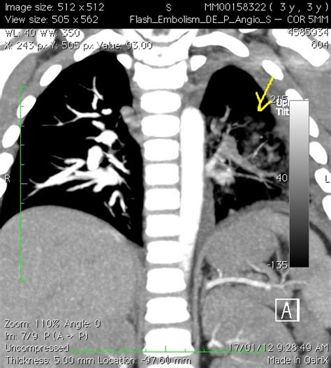 Pulmonary Embolism Ctpa Sumer S Radiology Blog