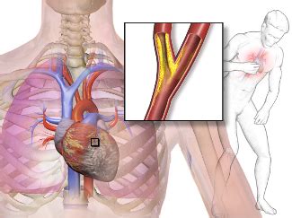 Prinzmetal S Angina Definition Causes Study